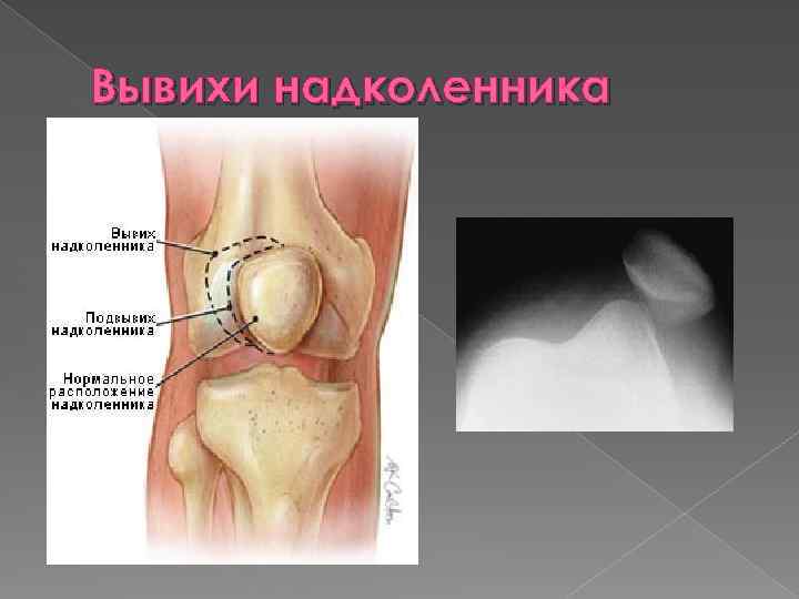 Перелом надколенника без смещения фото