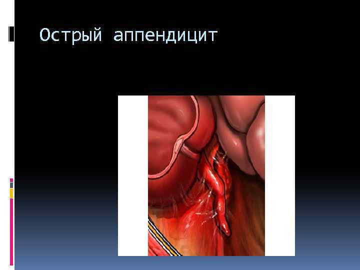 Острый аппендицит 