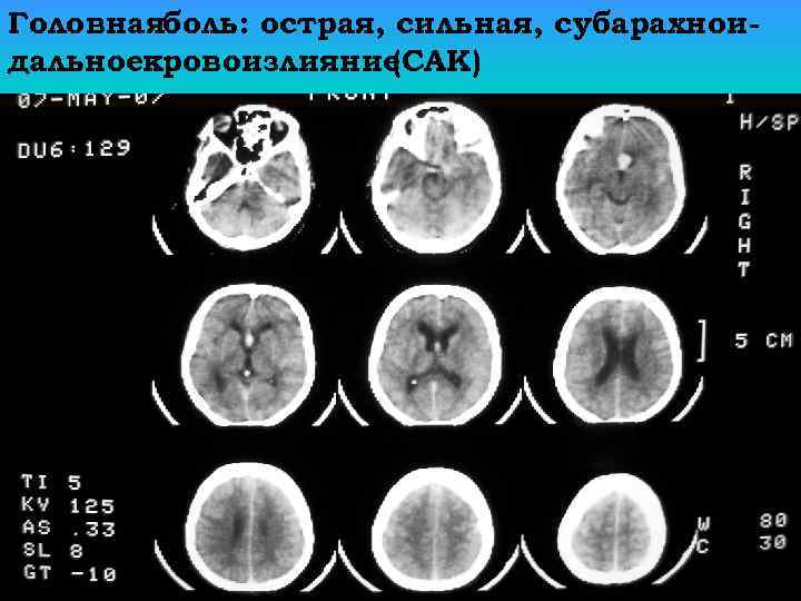 Головная боль: острая, сильная, субарахноидальное кровоизлияние (САК) 