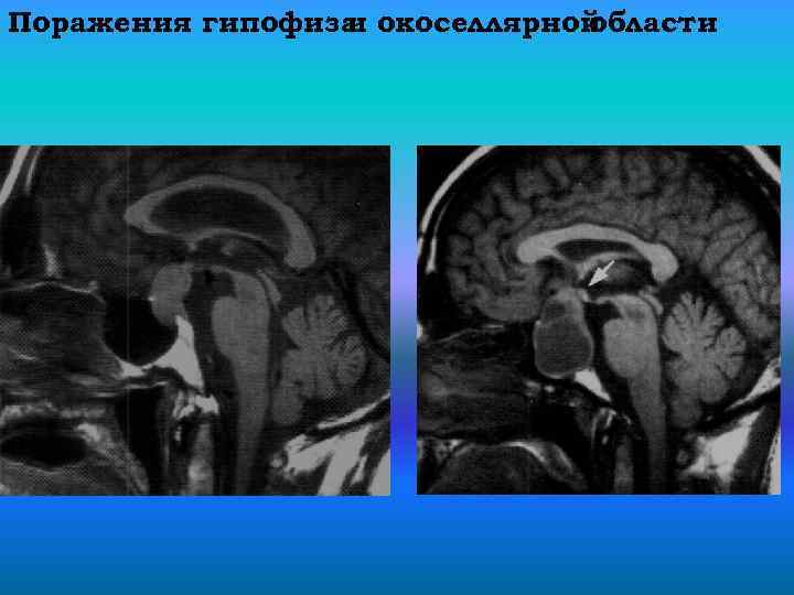 Поражения гипофиза окоселлярной и области 