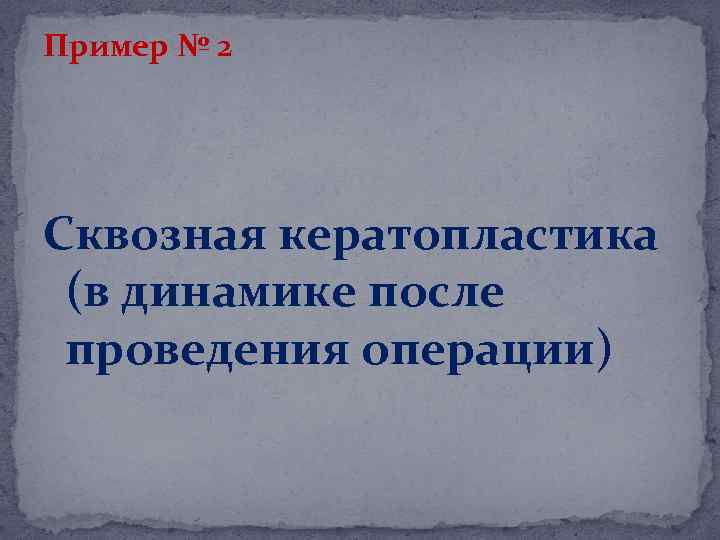 Пример № 2 Сквозная кератопластика (в динамике после проведения операции) 