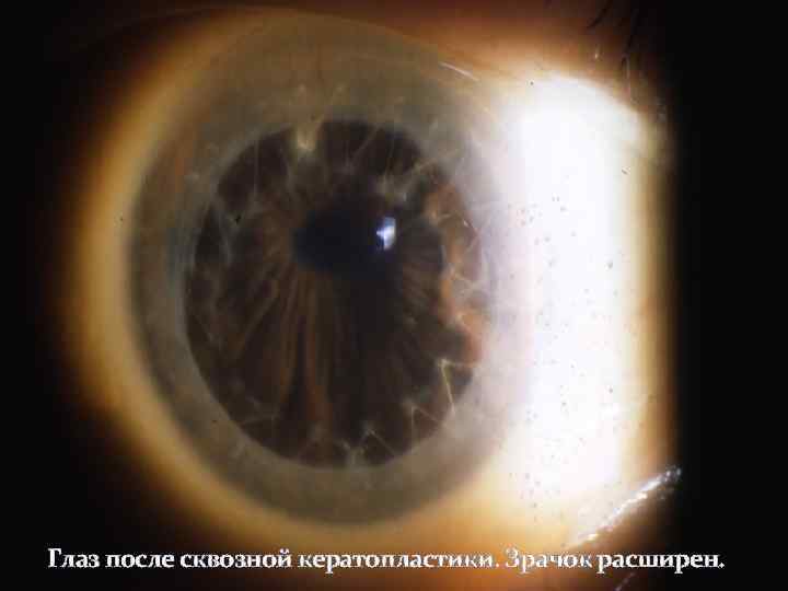 Глаз после сквозной кератопластики. Зрачок расширен. 