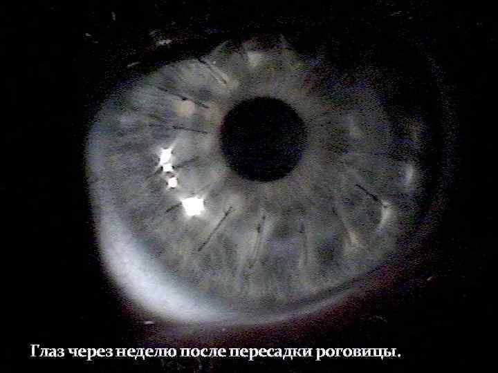 Глаз через неделю после пересадки роговицы. 