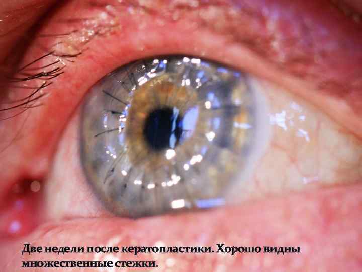 Две недели после кератопластики. Хорошо видны множественные стежки. 