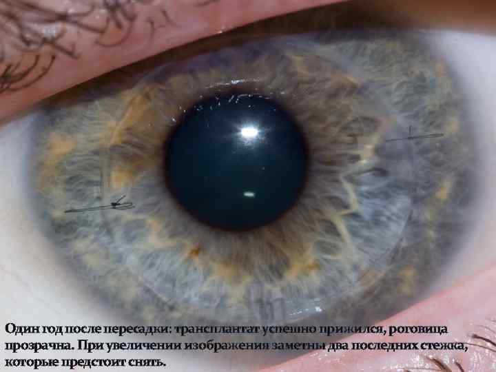 Один год после пересадки: трансплантат успешно прижился, роговица прозрачна. При увеличении изображения заметны два