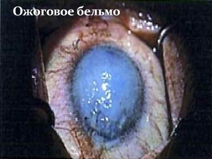 Ожоговое бельмо 