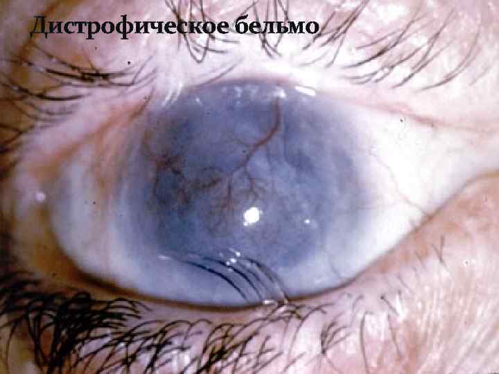 Дистрофическое бельмо 