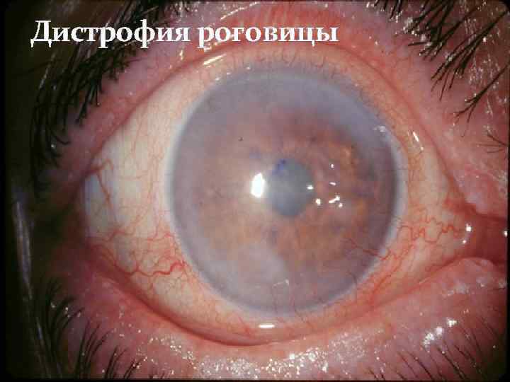 Дистрофия роговицы 