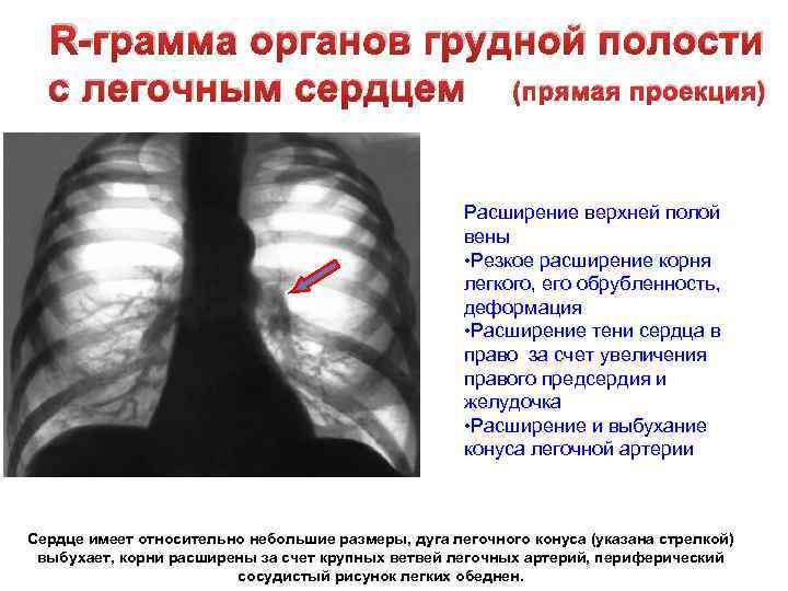 Усиление и деформация легочного рисунка