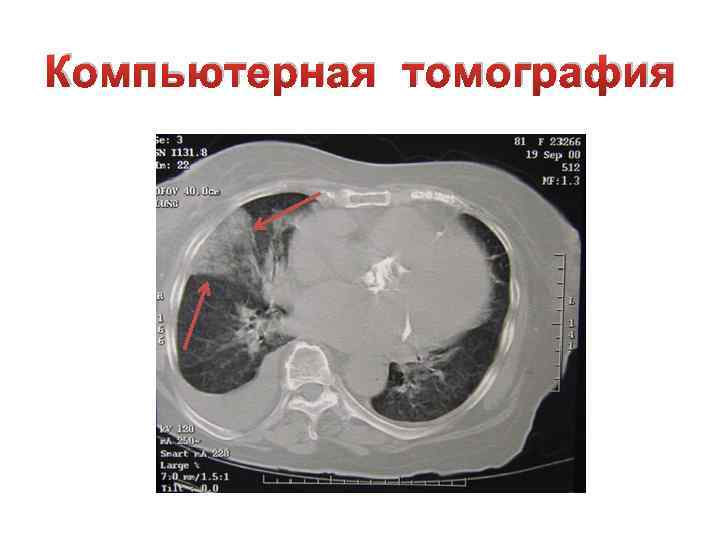 Компьютерная томография 