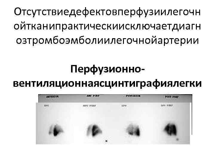 Отсутствиедефектовперфузиилегочн ойтканипрактическиисключаетдиагн озтромбоэмболиилегочнойартерии Перфузионновентиляционнаясцинтиграфиялегки х 