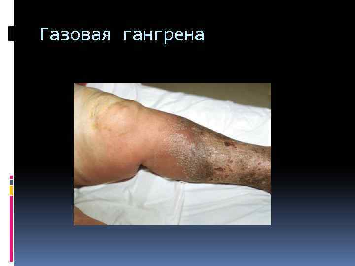 Газовая гангрена 