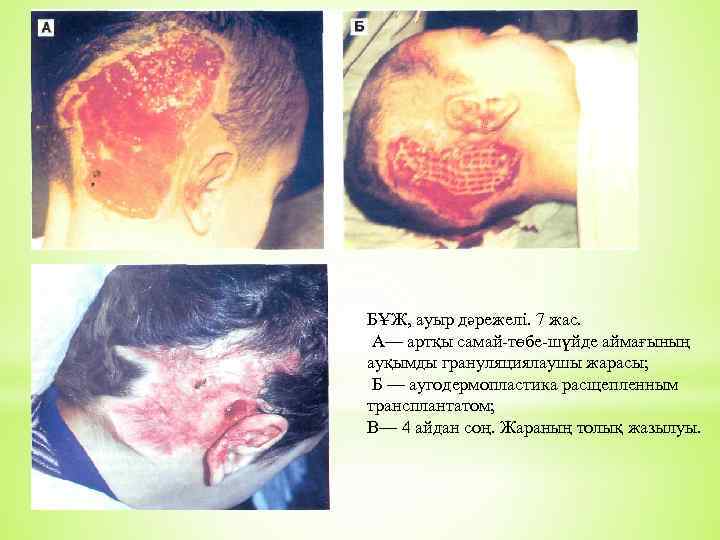 БҰЖ, ауыр дәрежелі. 7 жас. А— артқы самай-төбе-шүйде аймағының ауқымды грануляциялаушы жарасы; Б —