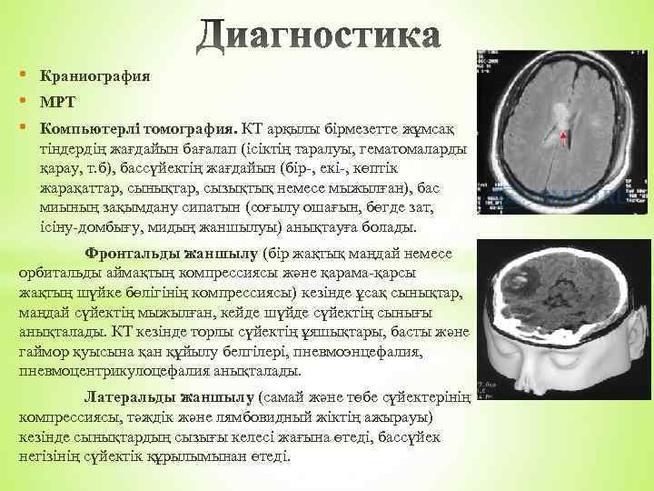  • • • Краниография МРТ Компьютерлі томография. КТ арқылы бірмезетте жұмсақ тіндердің жағдайын