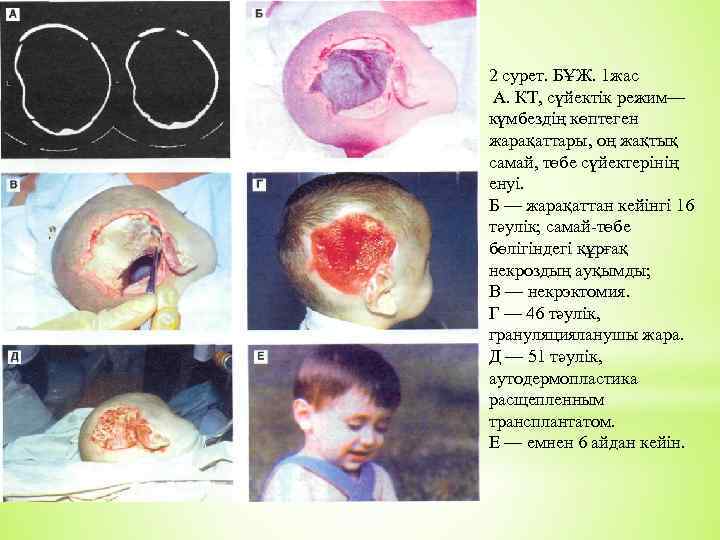2 сурет. БҰЖ. 1 жас А. КТ, сүйектік режим— күмбездің көптеген жарақаттары, оң жақтық