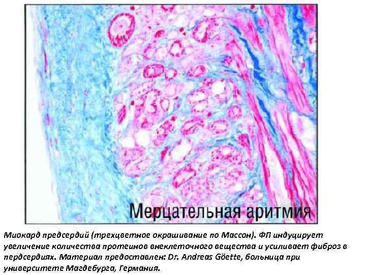 Миокард предсердий (трехцветное окрашивание по Массон). ФП индуцирует увеличение количества протеинов внеклеточного вещества и