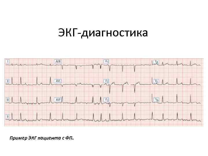 ЭКГ-диагностика Пример ЭКГ пациента с ФП. 