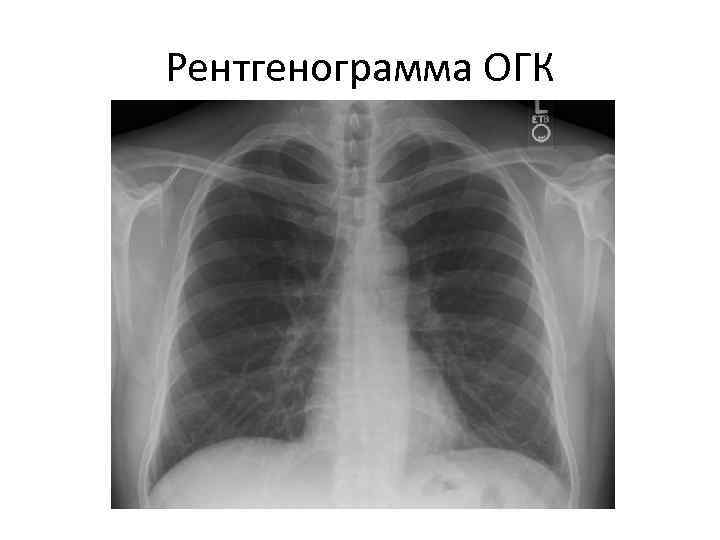 Рентгенограмма ОГК 