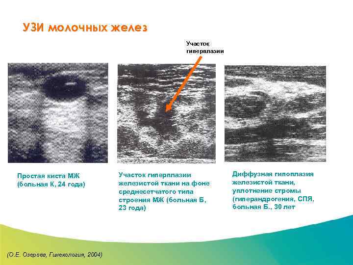 Специализированный семинар УЗИ молочных желез Участок гиперплазии Простая киста МЖ (больная К, 24 года)