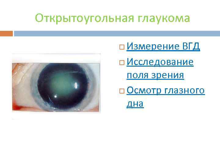 Открытоугольная глаукома Измерение ВГД Исследование поля зрения Осмотр глазного дна 