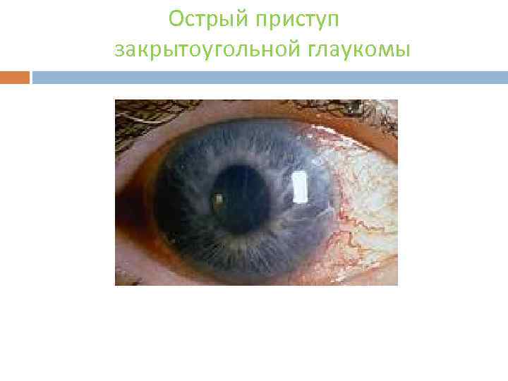 Острый приступ закрытоугольной глаукомы 