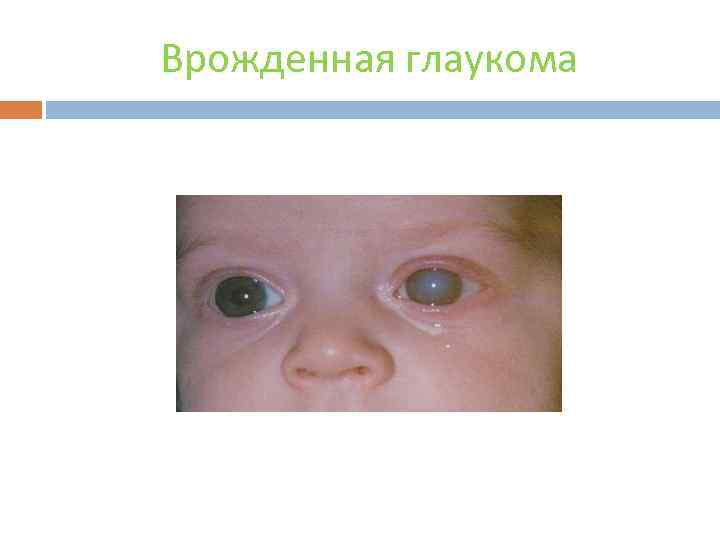 Врожденная глаукома 