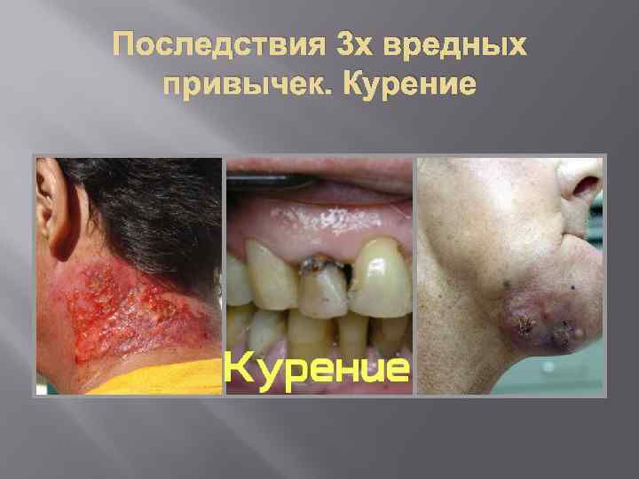 Последствия 3 х вредных привычек. Курение 