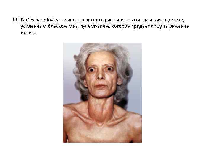 q Facies basedovica – лицо подвижно с расширенными глазными щелями, усиленным блеском глаз, пучеглазием,