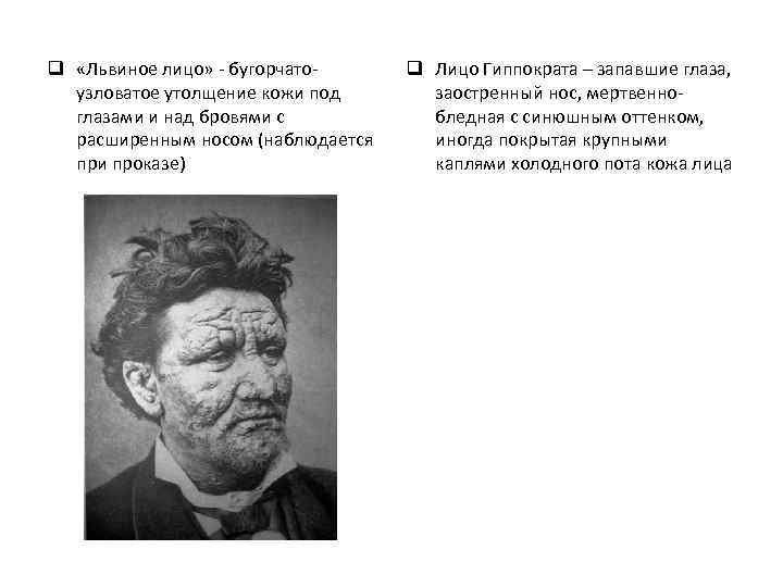 q «Львиное лицо» - бугорчатоузловатое утолщение кожи под глазами и над бровями с расширенным