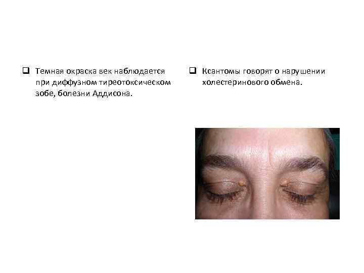 q Темная окраска век наблюдается при диффузном тиреотоксическом зобе, болезни Аддисона. q Ксантомы говорят