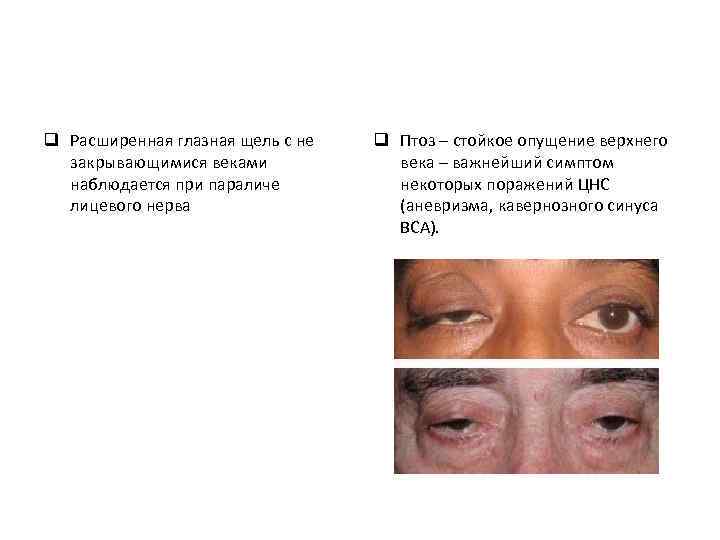 q Расширенная глазная щель с не закрывающимися веками наблюдается при параличе лицевого нерва q