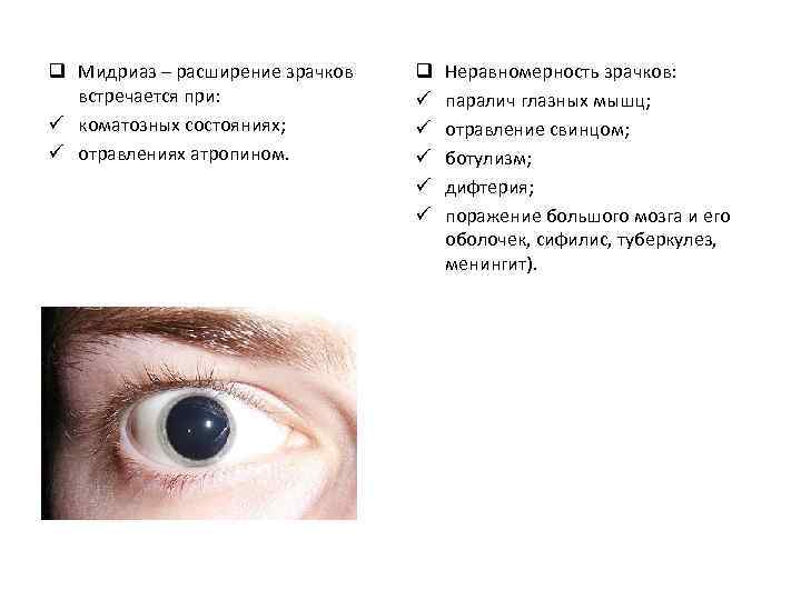 q Мидриаз – расширение зрачков встречается при: ü коматозных состояниях; ü отравлениях атропином. q