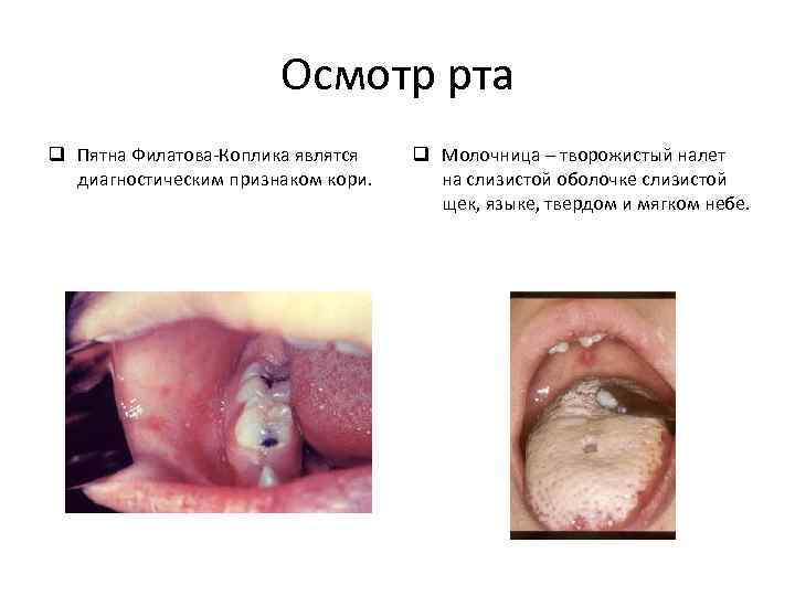 Осмотр рта q Пятна Филатова-Коплика являтся диагностическим признаком кори. q Молочница – творожистый налет