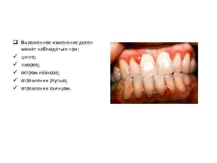 q Выраженное изменение десен может наблюдаться при: ü цинге; ü пиорее; ü остром лейкозе;