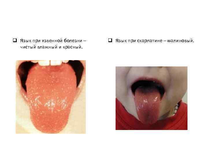 q Язык при язвенной болезни – чистый влажный и красный. q Язык при скарлатине