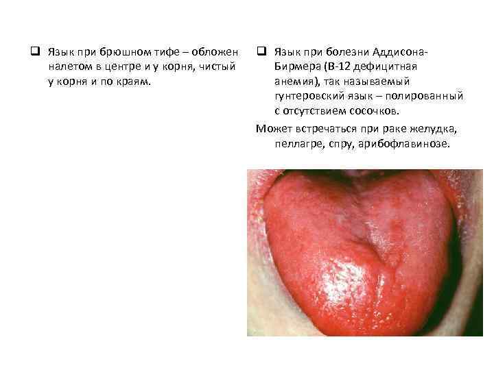 q Язык при брюшном тифе – обложен налетом в центре и у корня, чистый