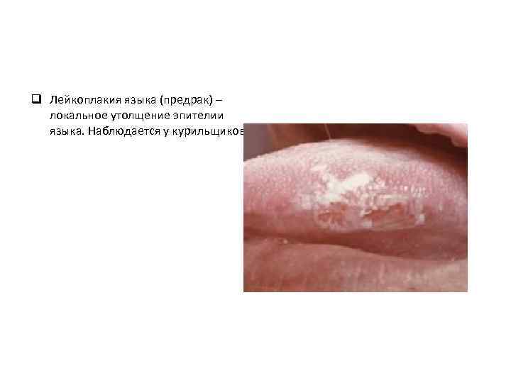 q Лейкоплакия языка (предрак) – локальное утолщение эпителии языка. Наблюдается у курильщиков. 
