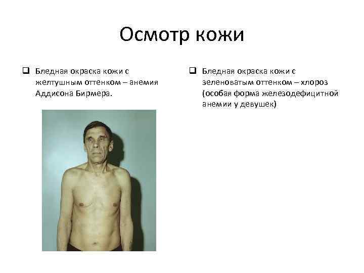 Осмотр кожи q Бледная окраска кожи с желтушным оттенком – анемия Аддисона Бирмера. q