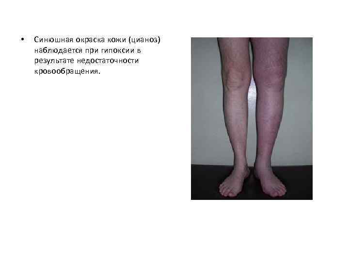  • Синюшная окраска кожи (цианоз) наблюдается при гипоксии в результате недостаточности кровообращения. 