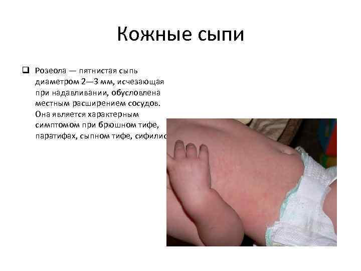 Кожные сыпи q Розеола — пятнистая сыпь диаметром 2— 3 мм, исчезающая при надавливании,