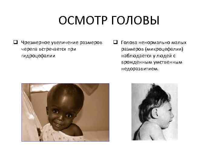 ОСМОТР ГОЛОВЫ q Чрезмерное увеличение размеров черепа встречается при гидроцефалии q Голова ненормально малых