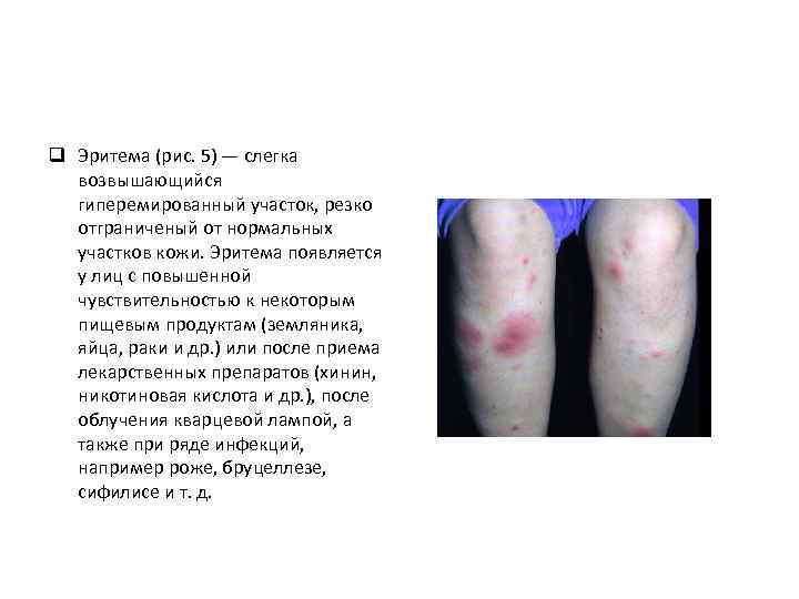 q Эритема (рис. 5) — слегка возвышающийся гиперемированный участок, резко отграниченый от нормальных участков