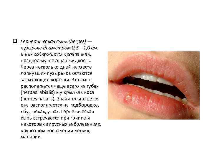 q Герпетическая сыпь (herpes) — пузырьки диаметром 0, 5— 1, 0 см. В них