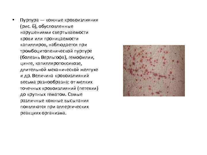 • Пурпура — кожные кровоизлияния (рис. 6), обусловленные нарушениями свертываемости крови или проницаемости