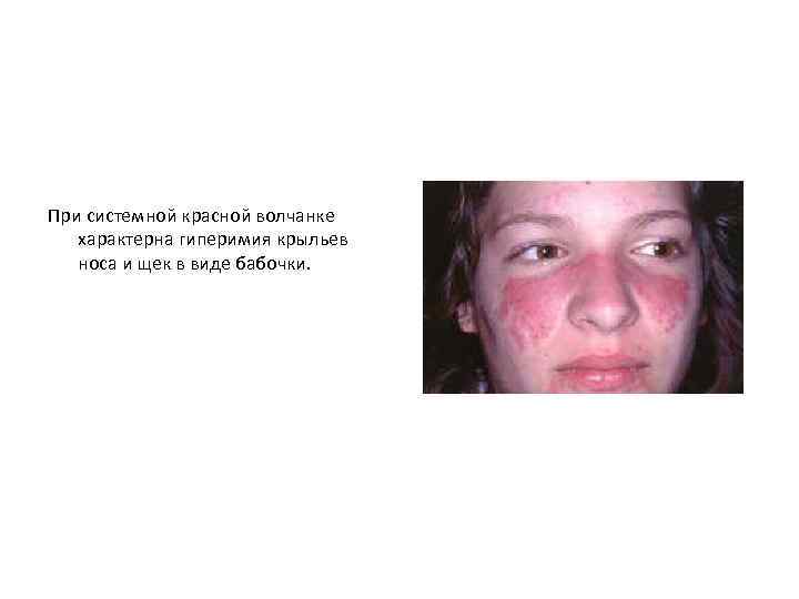 При системной красной волчанке характерна гиперимия крыльев носа и щек в виде бабочки. 
