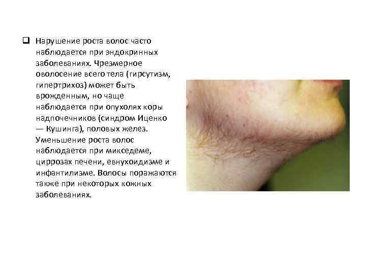 q Нарушение роста волос часто наблюдается при эндокринных заболеваниях. Чрезмерное оволосение всего тела (гирсутизм,