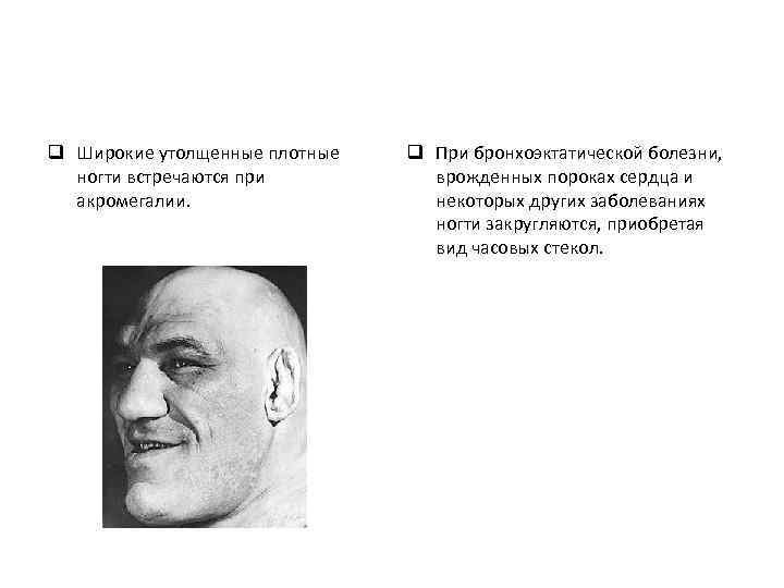 q Широкие утолщенные плотные ногти встречаются при акромегалии. q При бронхоэктатической болезни, врожденных пороках