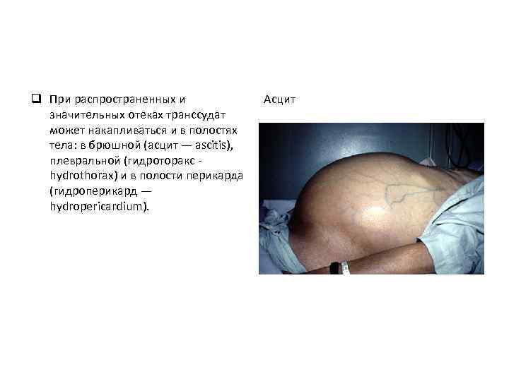 q При распространенных и значительных отеках транссудат может накапливаться и в полостях тела: в