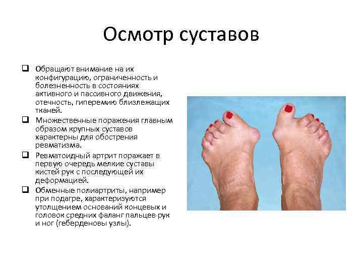Осмотр суставов q Обращают внимание на их конфигурацию, ограниченность и болезненность в состояниях активного