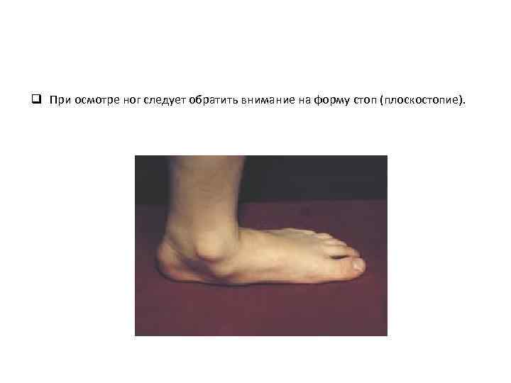 q При осмотре ног следует обратить внимание на форму стоп (плоскостопие). 
